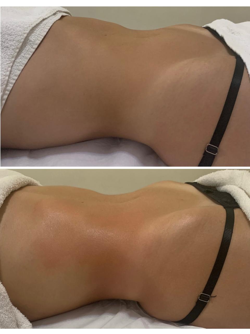 Resultado antes e depois — Método Renata França na Unolaser 1