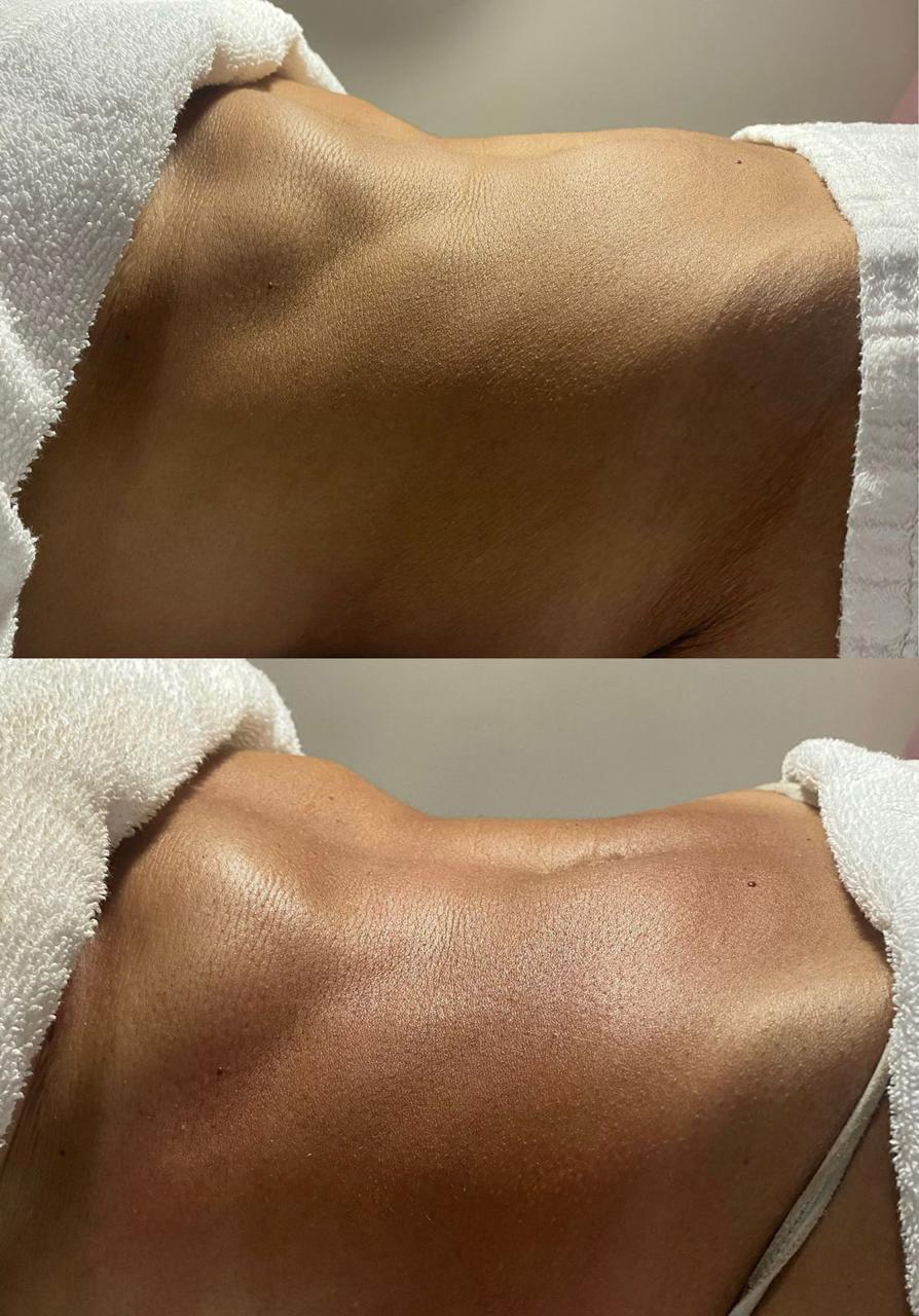 Resultado antes e depois — Método Renata França na Unolaser 2