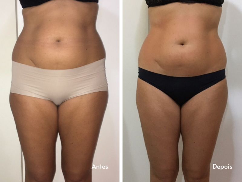 Antes e depois 1