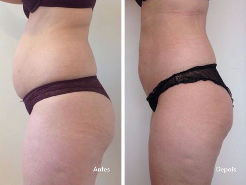 Antes e depois 2