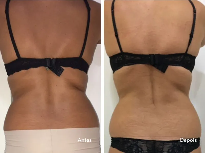 Carboxiterapia Corporal — imagem 3