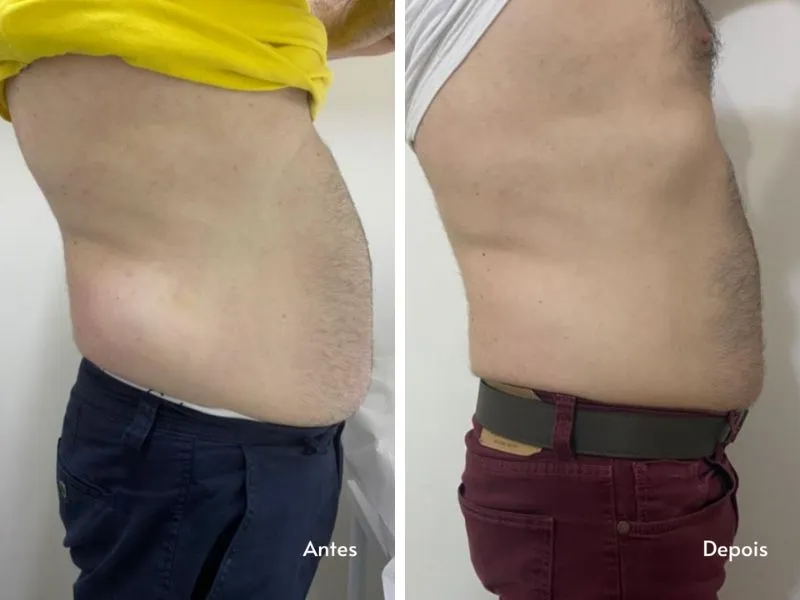 Carboxiterapia Corporal — imagem 2
