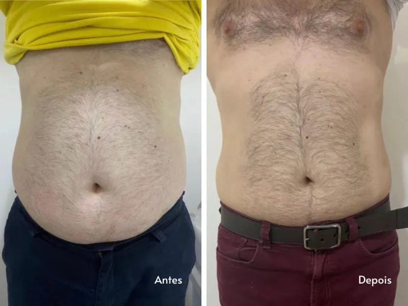 Carboxiterapia Corporal — imagem 1