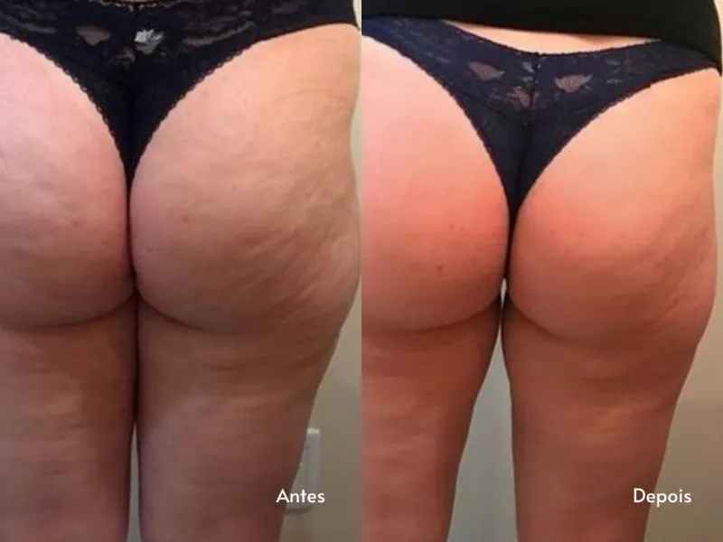 Endermologia — imagem 3