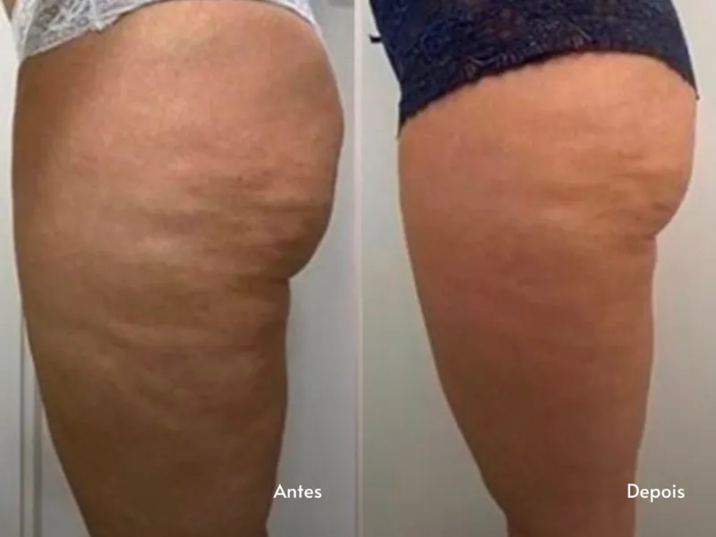 Endermologia — imagem 4