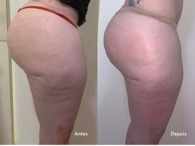 Endermologia — imagem 1