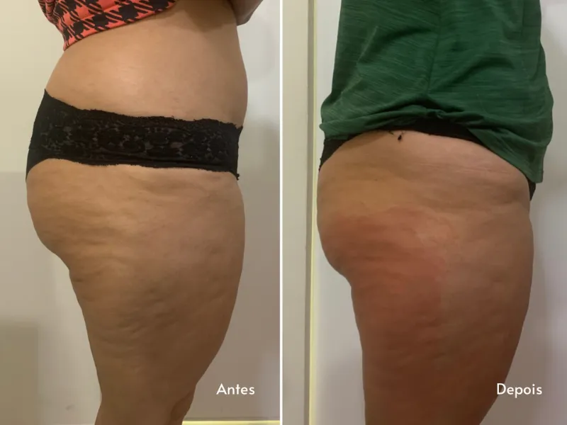 Endermologia — imagem 2