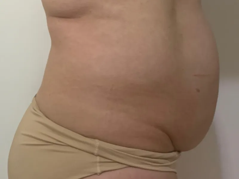 Lipo sem Corte — antes do tratamento na Unolaser