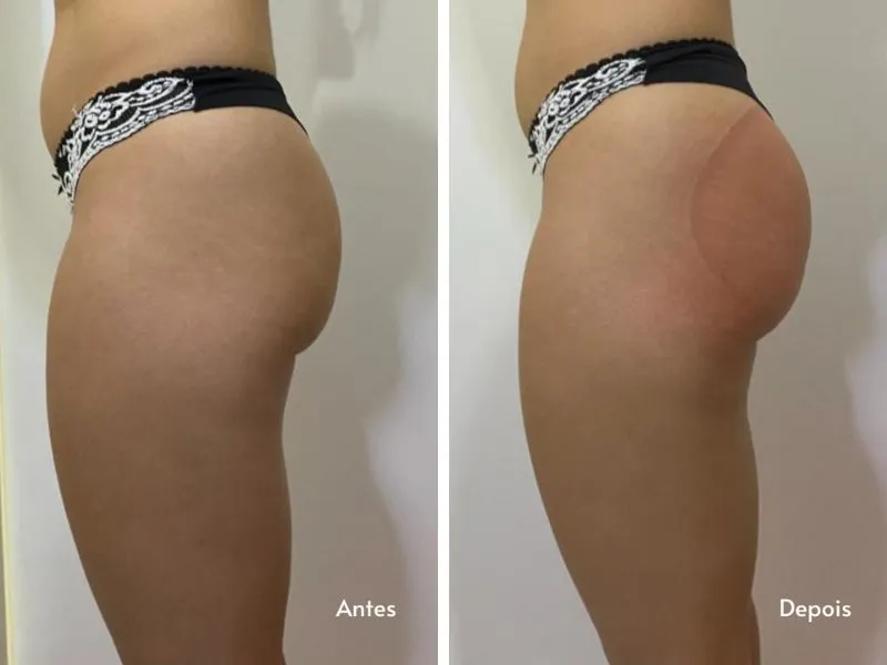 Ventosa Bumbum na Nuca — imagem 1