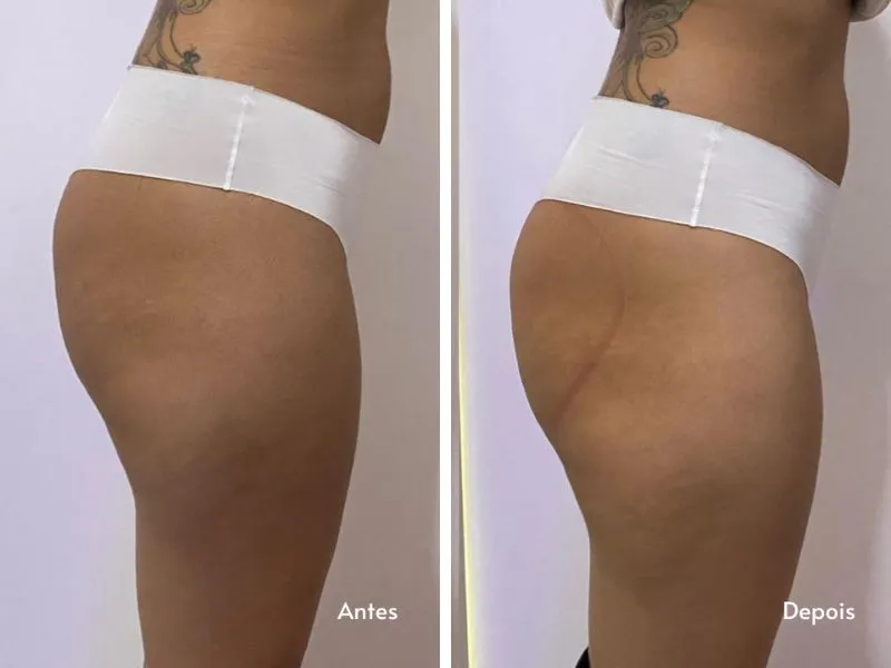 Ventosa Bumbum na Nuca — imagem 2