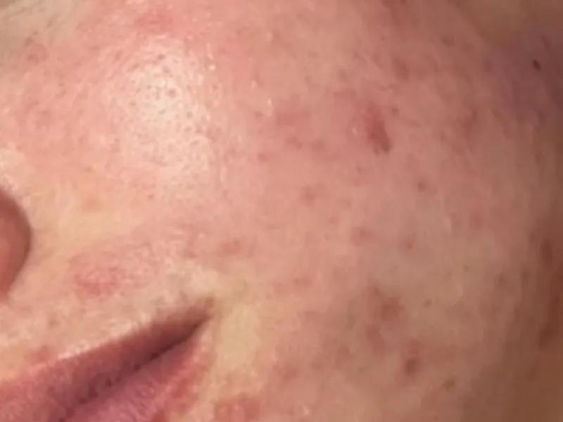 Tratamento de Acne — imagem 1