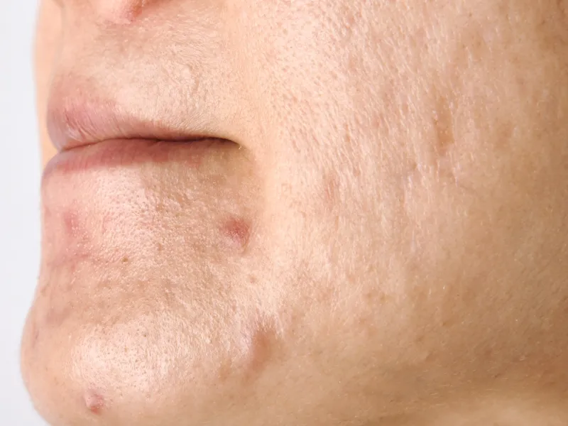 Tratamento de Acne — imagem 2