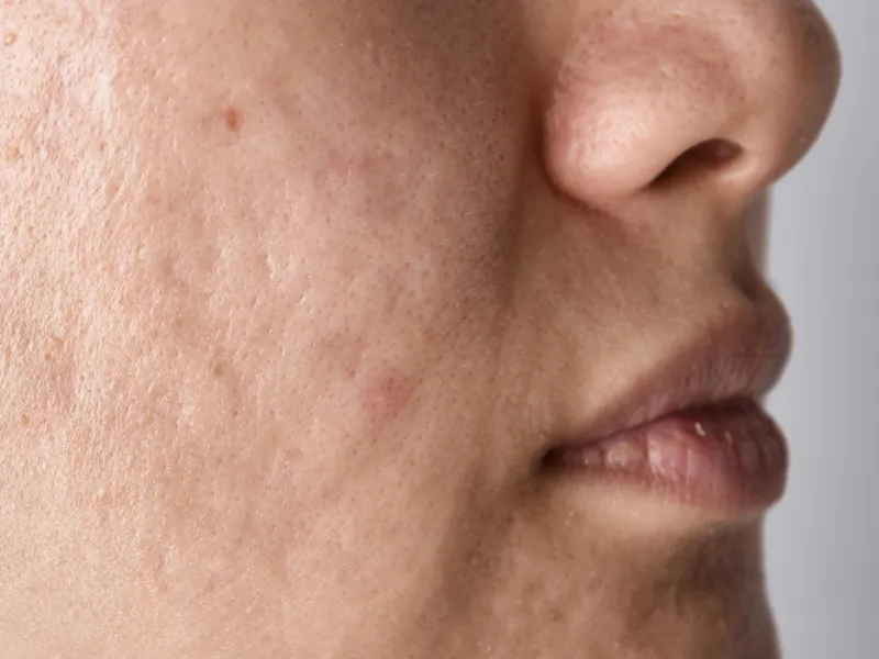 Tratamento de Acne — imagem 4