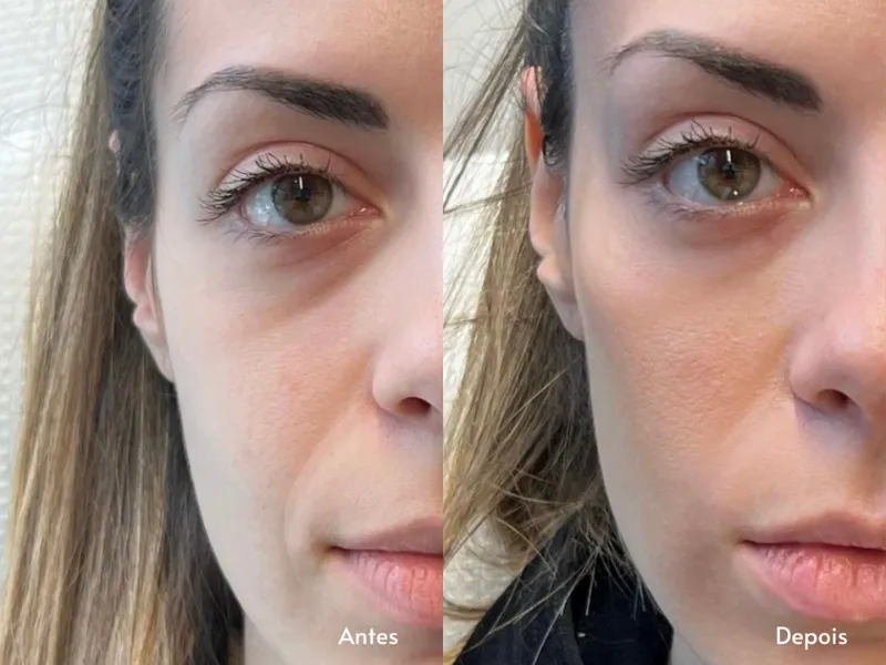 Carboxiterapia Facial — imagem 4