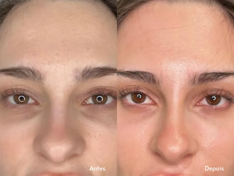 Carboxiterapia Facial — imagem 2