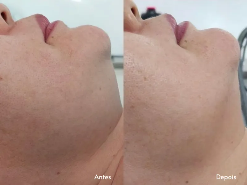Carboxiterapia Facial — imagem 1