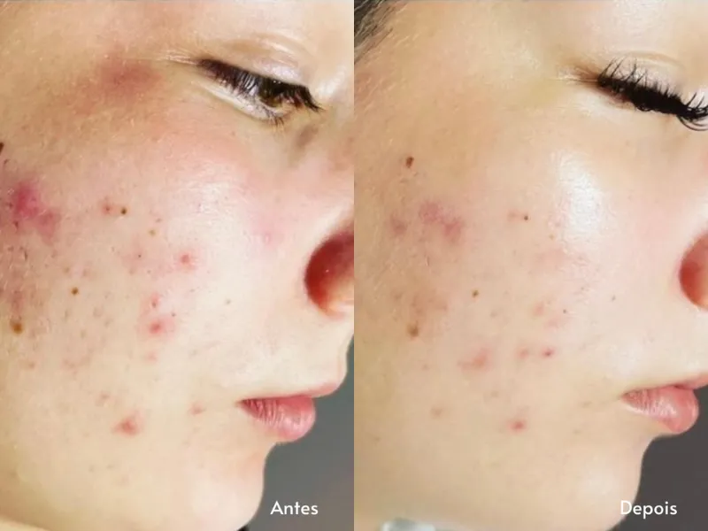Carboxiterapia Facial — imagem 3