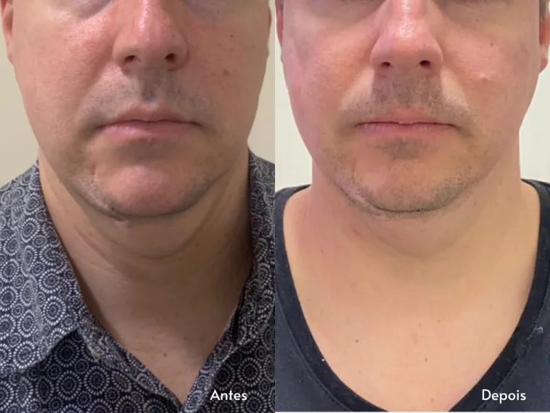 Enzimas Faciais sem Agulhas — imagem 3