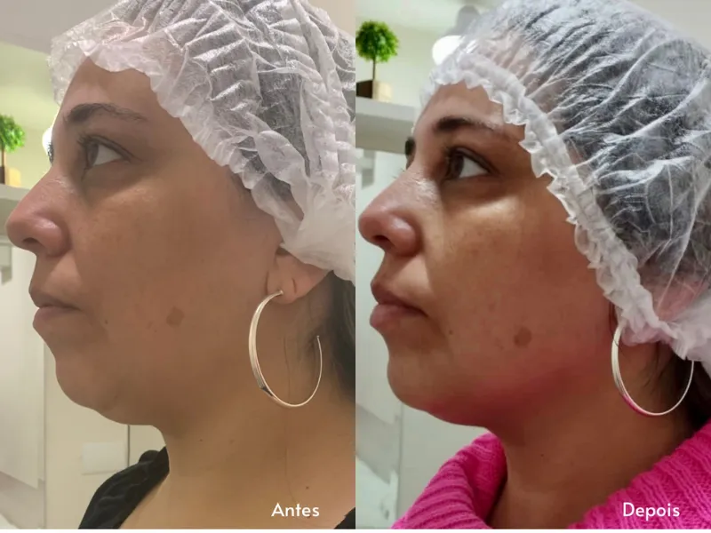 Enzimas Faciais sem Agulhas — imagem 2