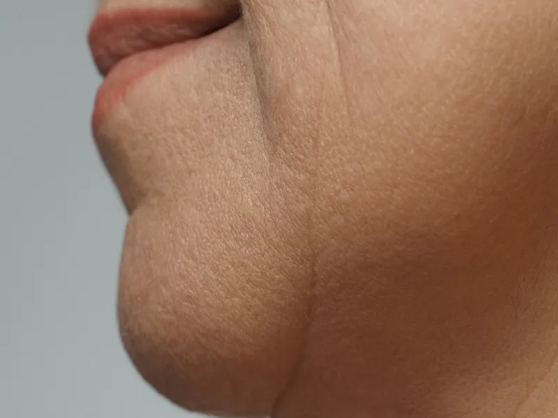 Flacidez Facial — imagem 2