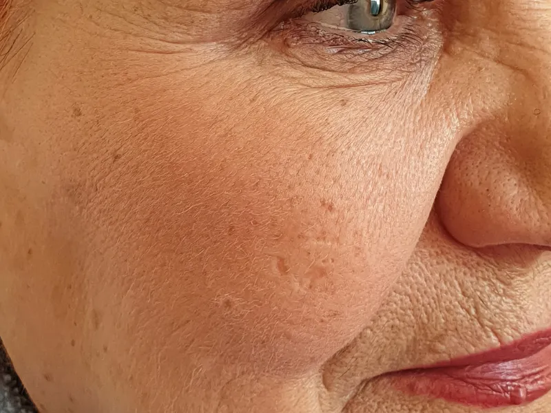 Flacidez Facial — imagem 1