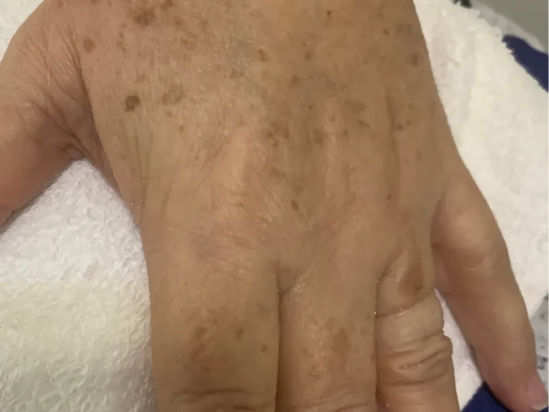 Manchas (Melasma) — antes do tratamento na Unolaser