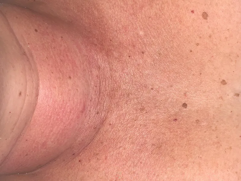 Manchas (Melasma) — depois do tratamento na Unolaser