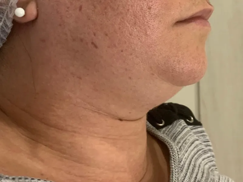 Tratamento de Papada — imagem 3