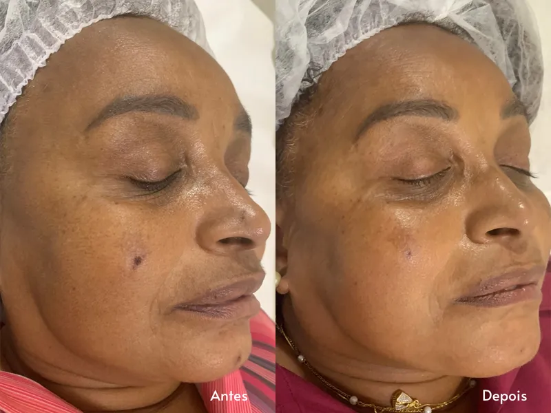 Peeling de Diamante — imagem 2