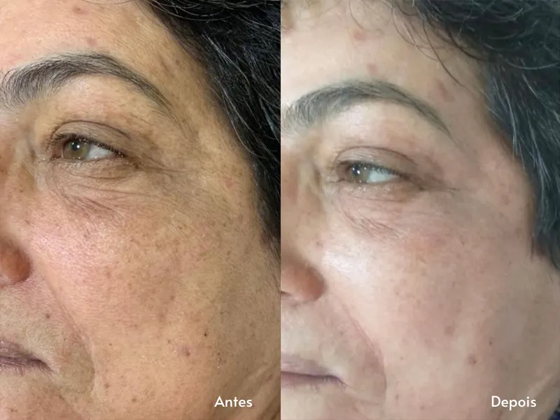 Peeling de Diamante — imagem 1