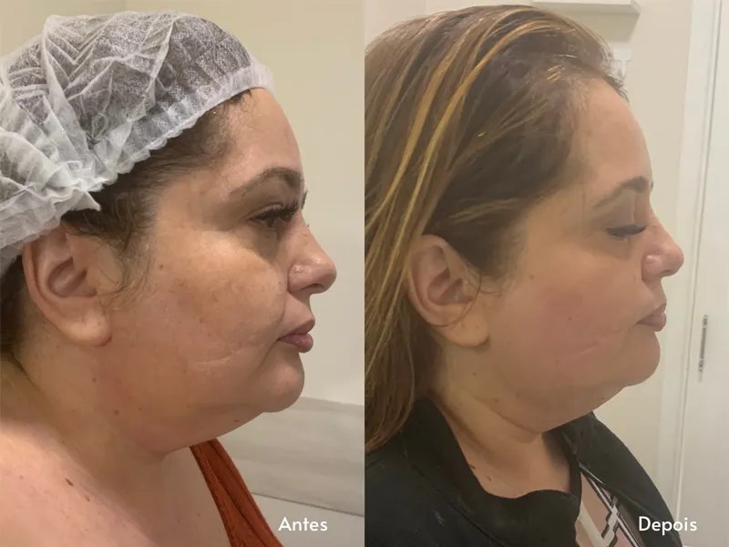 Peeling de Diamante — imagem 3