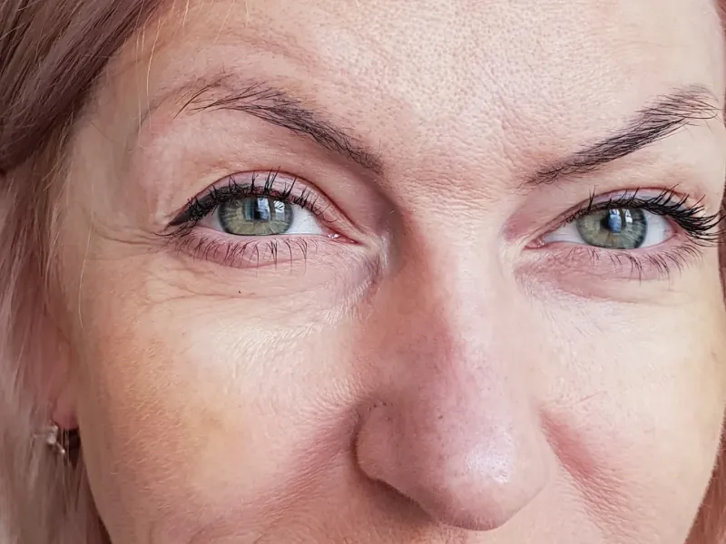 Rejuvenescimento Facial — imagem 1
