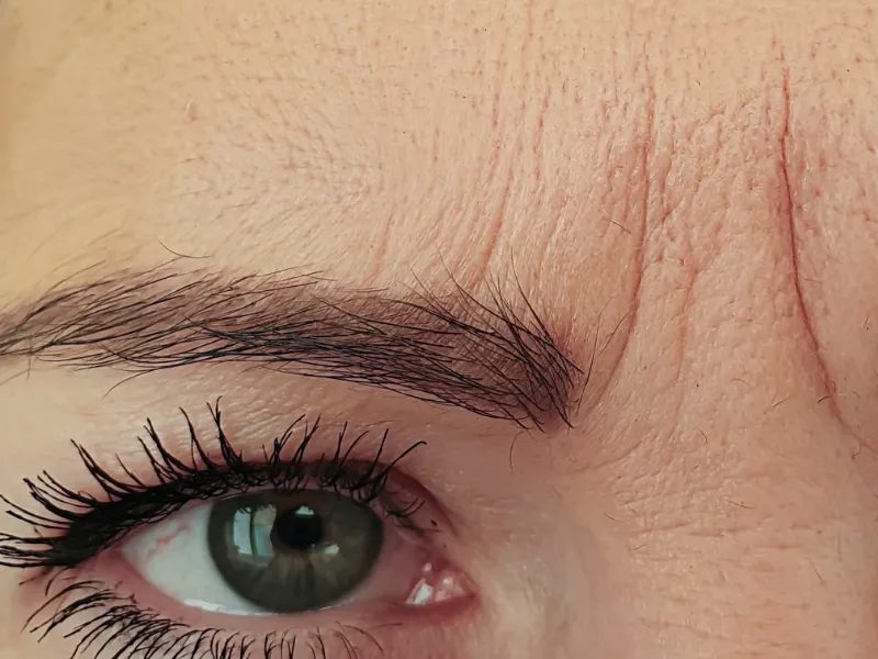 Rejuvenescimento Facial — imagem 2