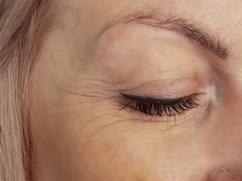 Rejuvenescimento Facial — imagem 4